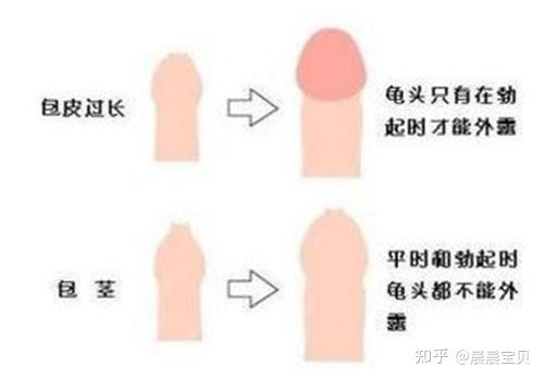 女人割完皮包后的恢復(fù)之路，女人割皮包后的恢復(fù)與重塑之路