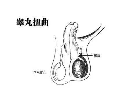 睪丸扭轉(zhuǎn)的癥狀及其影響，睪丸扭轉(zhuǎn)的癥狀與影響概述