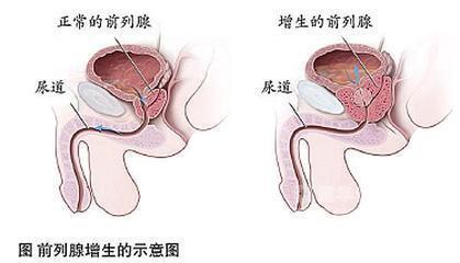 按摩前列腺的方法，了解、實踐與注意事項，按摩前列腺，方法、實踐與注意事項全解析