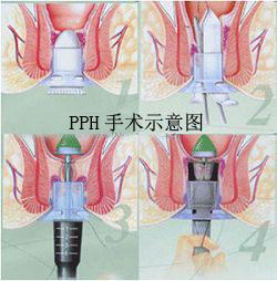 吻合器手術(shù)后恢復(fù)圖，了解恢復(fù)過程，促進(jìn)健康復(fù)原，吻合器手術(shù)后恢復(fù)全圖解，了解恢復(fù)過程，助力健康復(fù)原