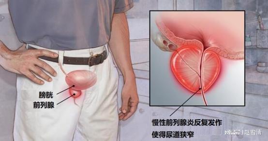 跑步治愈了我的前列腺問(wèn)題，一種健康生活的力量，跑步治愈前列腺問(wèn)題，健康生活的力量之源