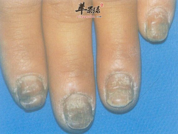 治療灰指甲偏方，古老智慧與現(xiàn)代健康的交融，古老智慧與現(xiàn)代健康，灰指甲治療偏方全解析
