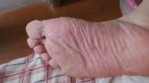 解決腳癢脫皮起水泡爛腳丫，藥物治療與護理建議，解決腳癢脫皮起水泡爛腳丫，藥物治療與護理建議全解析