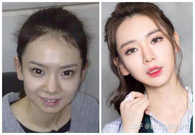 戚薇整容事件，前后對比深度解析，戚薇整容事件深度解析，前后對比揭示真相