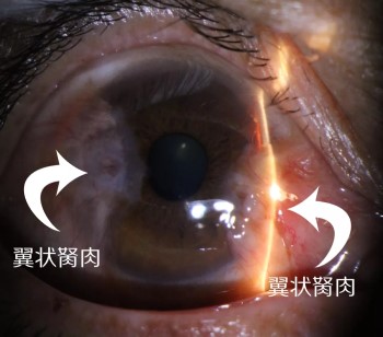 胬肉，探究其成因、影響與治療方法，胬肉，成因、影響與治療方法探究
